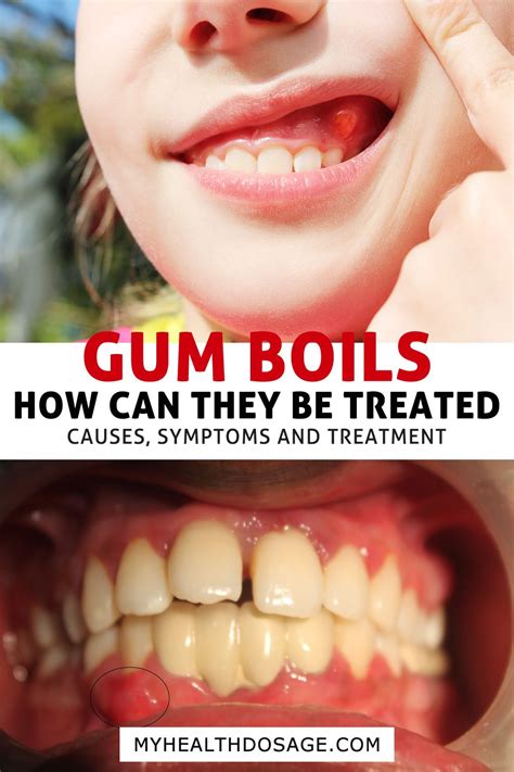 Gum Boils What They Are And How To Treat Them In 2021 Canker Sore On