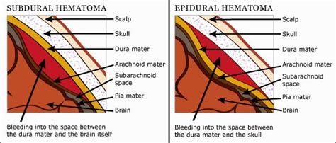 Paramedic Student Central Subdural And Epidural Hematoma