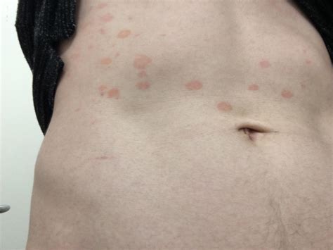 What Are These Red Spots Noticed A Couple On My Stomach A Little While Back And More Have Now