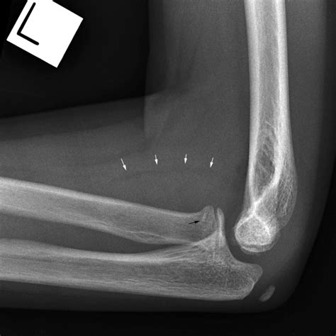 Soft Tissue Signs The Elbow Wikiradiography