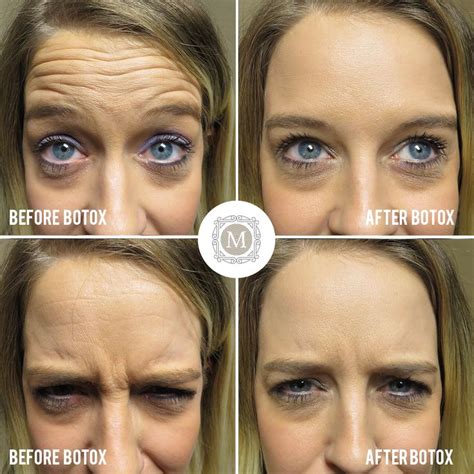 This Patient Had 20 Units Of Botox For Forehead Wrinkles Frown Lines