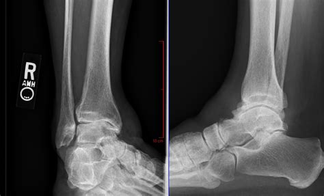 Ankle Arthritis Paul H Kim Md
