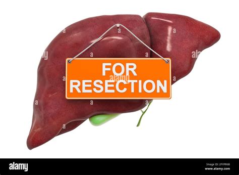 Liver Resection Concept Human Liver With For Resection Hanging Sign