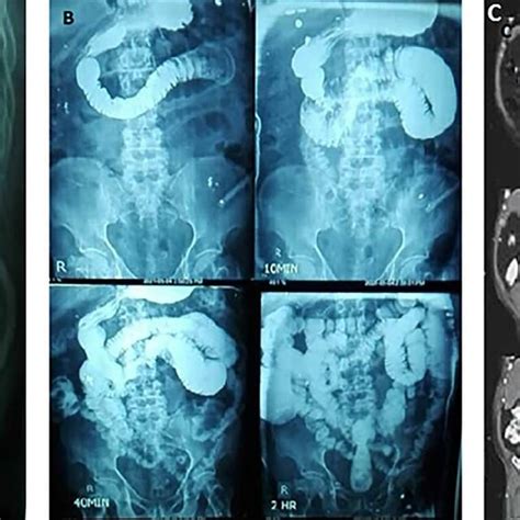 Post Operative Ileus Is Obvious In Kub A F Luroscopic Barium Study
