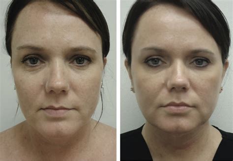Thermage Skin Tightening By Dermatologists In Crest Hill Naperville