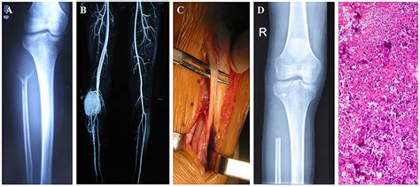 An Invasive Giant Cell Tumour Of The Proximal Right Fibula Treated With
