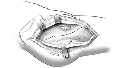 Schematic Diagram Of The Direct Lateral Approach Showing That The