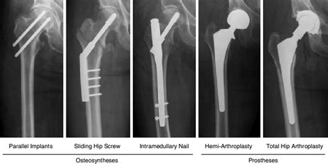 Surgery For Hip Fracture Doctorvisit