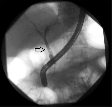 Pulseless Electrical Activity Arrest Due To Air Embolism During