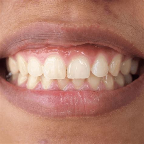 How Do I Know If I Have Gum Disease Redmires Dental Care Website