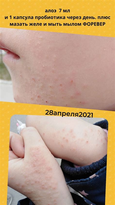 Высыпания на щеках и руках у ребенка Вопрос аллергологу 03 Онлайн