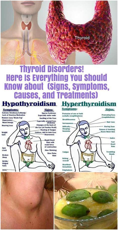 Here Is Everything You Should Know About Thyroid Disorders Signs