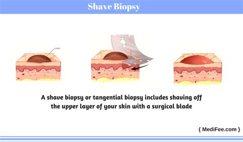 Shave Biopsy What Is A Biopsy Trillium Creek Dermatology Other