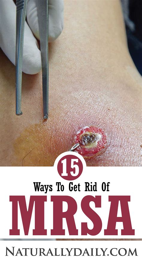 15 Ways To Get Rid Of Mrsa Naturally Staph Infection Remedies Bug