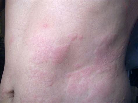 Hives Vs Rash What S The Difference Between Them