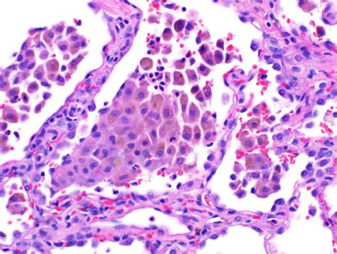 Ali W Hemosiderin Macrophages — 6 Patterns Of Pulmonary Pathology
