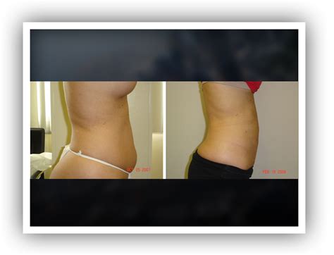 Abdomen Neck Arms Thighs Love Handles Before After Photos