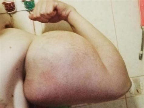 Russian Teen Shows Insane Amount Of Synthol In His Arms Fitness Volt