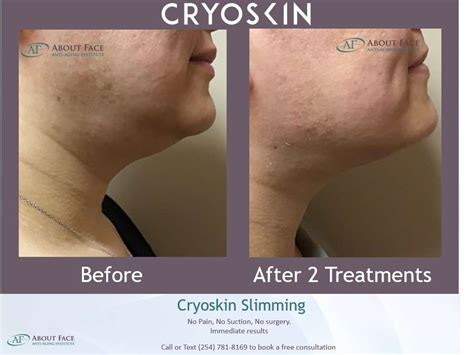 Cryoskin Facial How It Works And What Are Its Benefits