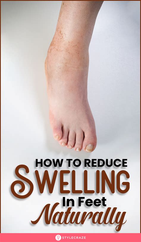 16 Effective Home Remedies For Swollen Feet In 2020 Swelling Remedies