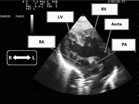 Transthoracic Echocardiography Subcostal Long Axis Views Two