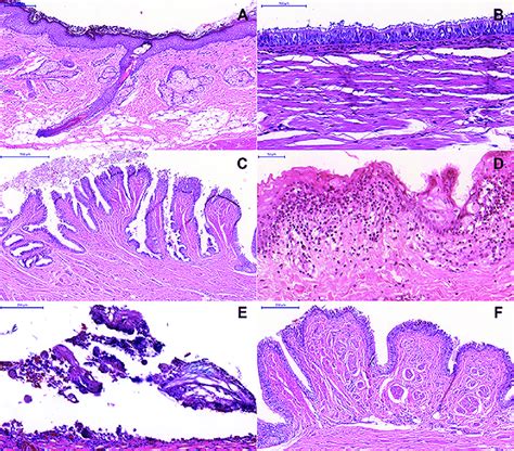 Histopathological Features Of Dermoid Cysts Dcs Hematoxylin And Eosin