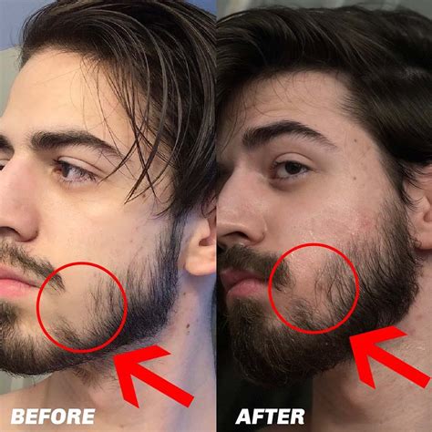 Derma Roller For Beard Treatment For Boosting Your Beard Growth