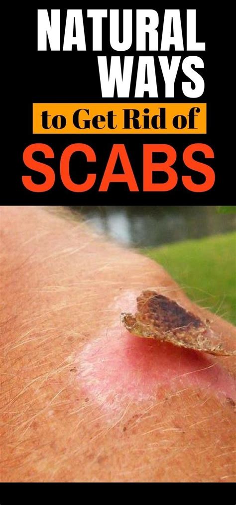 In General Scabs Are Defined As The Natural Process That Protects Your