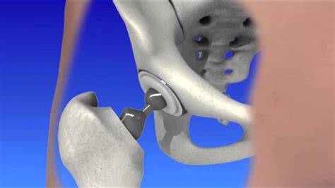 Minimally Invasive Hip Replacement Arthroplasty Youtube