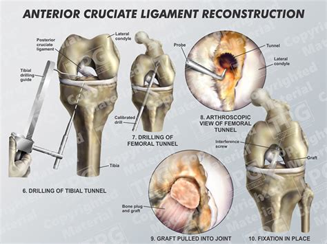 Anterior Cruciate Ligament Reconstruction 2 Order
