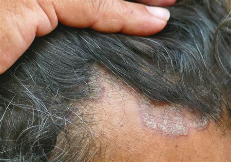 Itchy Red Spots On Scalp