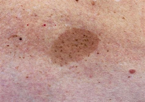 Dark Brown Spots On Skin