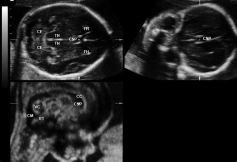 Fetal Head Ultrasound