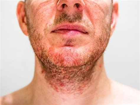 Seborrheic Dermatitis Symptoms Causes Treatment And Photos