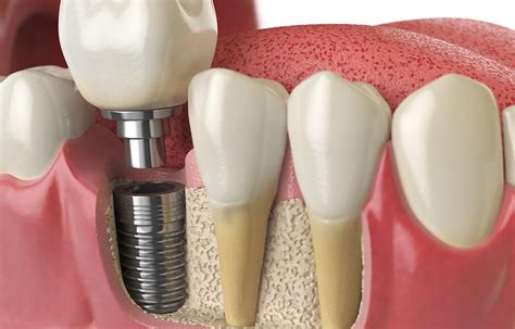 Dental Bridge Prosthesis Or Implant Next Smile