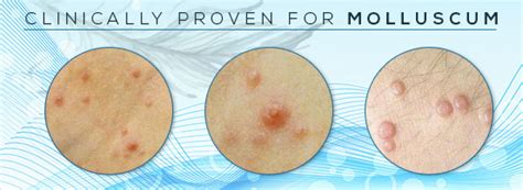 What Is Molluscum Contagiosum And Its Treatment Shytobuy
