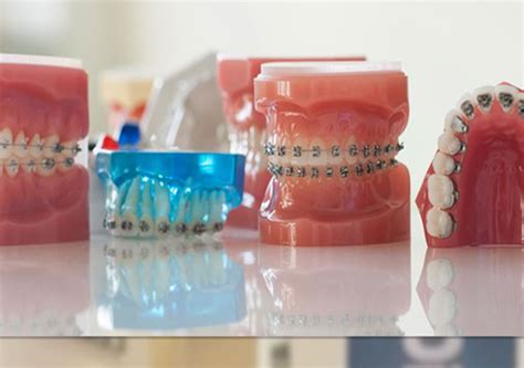 Zahnspangen gibt es heute in einer großen bandbreite und in vielen varianten, je nach einsatzgebiet und zahnmedizinischer indikation. Was ist der Unterschied zwischen einer festen und einer ...