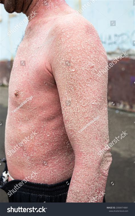 Man Psoriasis On His Back Neck Stock Photo 2008974881 Shutterstock