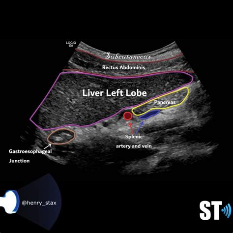 Liver Anatomy And Protocol Basics Sonographic Tendencies Medical