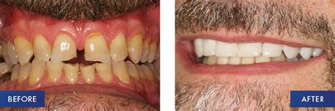 In some rare cases, damage to your. Porcelain Veneers Treatment | FirstBite Dentist Essendon