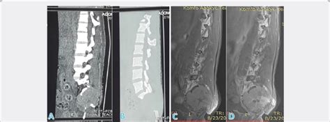 A And B Sagittal View Lumbosacral Ct Scan With Soft Tissue And Bone