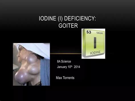 Ppt Iodine I Deficiency Goiter Powerpoint Presentation Free