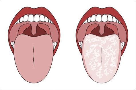 How Treat Oral Thrush Online Offer Save 50 Jlcatjgobmx