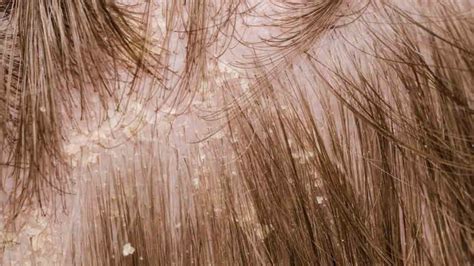 Useful Mild Treatment Solutions For Scalp Psoriasis Problem The Key