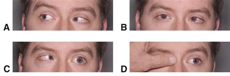 Sixth Nerve Palsy American Academy Of Ophthalmology
