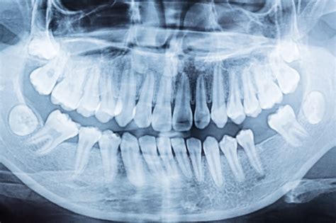 Premium Photo Panoramic Dental X Ray Of A Mouth Left And Right Side