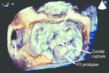 D TEE Of The Mitral Valve Enface View Shows The Mitral Valve Download Scientific Diagram