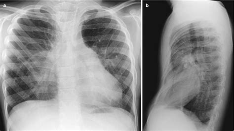 Pediatric Diffuse Lung Disease Radiology Key