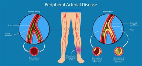 Peripheral Artery Disease Cramping Pain Or Tiredness