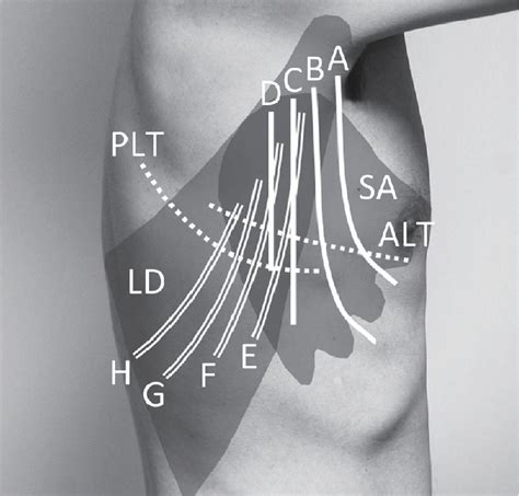 Figure 1 From Design Variations In Vertical Muscle Sparing Thoracotomy